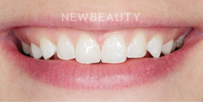 Dr. Nathan Hoffman - Gum Lift, Teeth Whitening & Veneers - Before