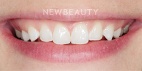Dr. Nathan Hoffman - Gum Lift, Teeth Whitening & Veneers - Before