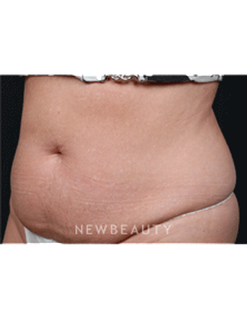 Dr. Ruth Hillelson Coolsculpting - Before
