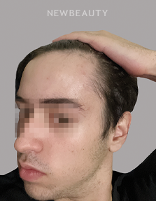 Dr. Anna Chacon - Alopecia - 34279552 - Before