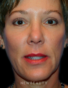 Dr. Kelly Bomer Eyelid Lift - After