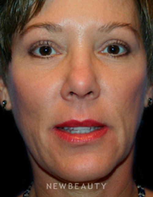Dr. Kelly Bomer Eyelid Lift - After