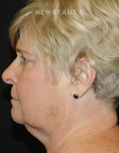 Dr. Joel Schlessinger - Reducing Excess Chin Fat - Before