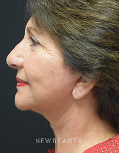 Dr. Jeffrey B. Wise - Eyelift, Facelift & Lasers - After