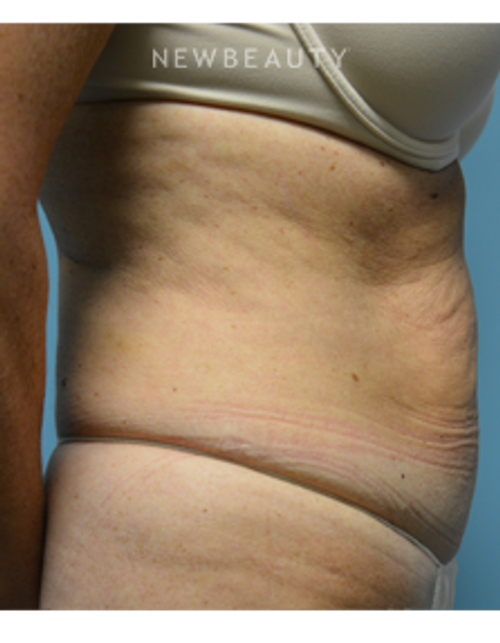 Dr. Ruth Hillelson - Thermage - Before
