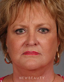 Dr. Henry Mentz Facelift, Eye Lift, Neck lift, Lasers - After