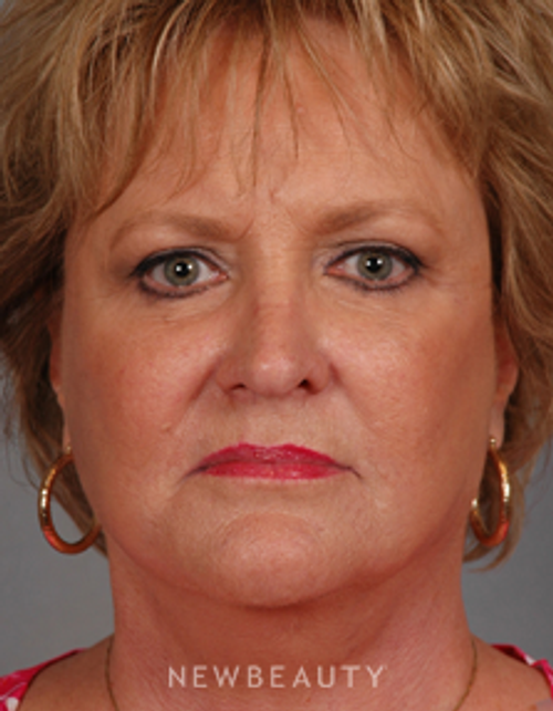 Dr. Henry Mentz Facelift, Eye Lift, Neck lift, Lasers - After