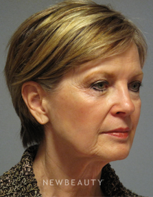 Dr. Mentz - Eyelift, Facelift, Necklift - Before