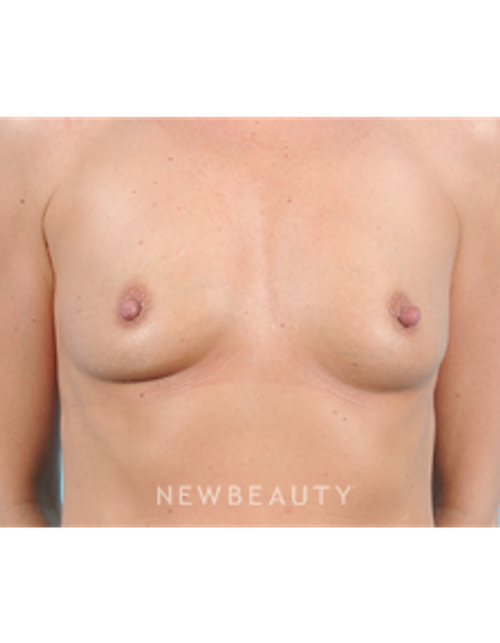 Dr. Bradley Bengtson - Breast Augmentation - Before