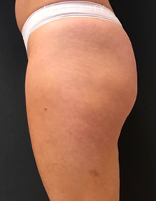 Dr. Janet Allenby - EmSculpt - After