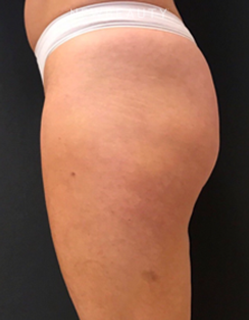 Dr. Janet Allenby - EmSculpt - After