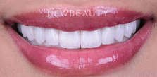 Dr. Husam Almunajed - Gum Lift & Veneers - 32922683 - After