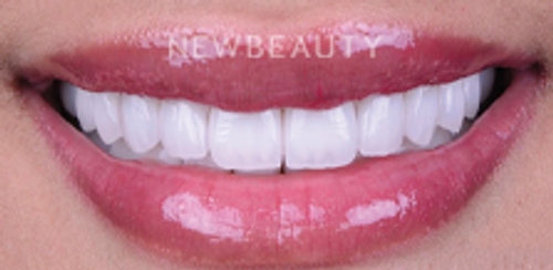Dr. Husam Almunajed - Gum Lift & Veneers - 32922683 - After