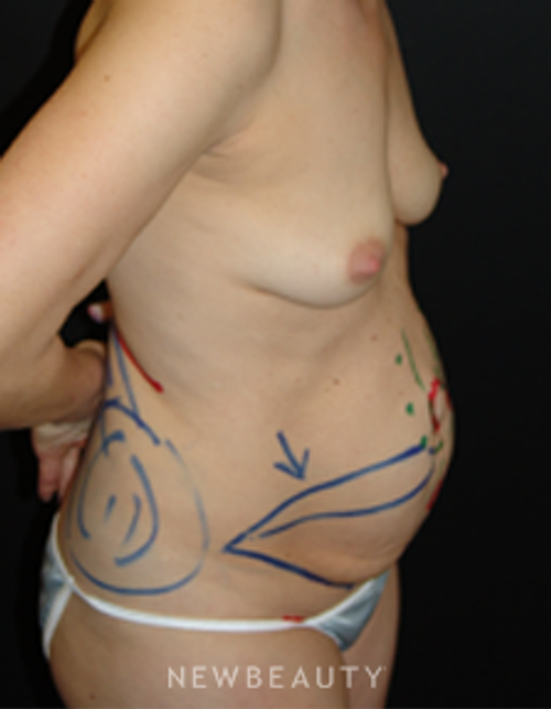 Dr. Mokhtar Asaadi Breast Augmentation, Tummy Tuck, Mommy Makeover - Before