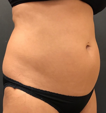 Dr. Janet Allenby - CoolSculpting - Before