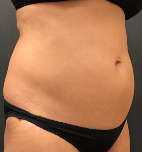 Dr. Janet Allenby - CoolSculpting - Before