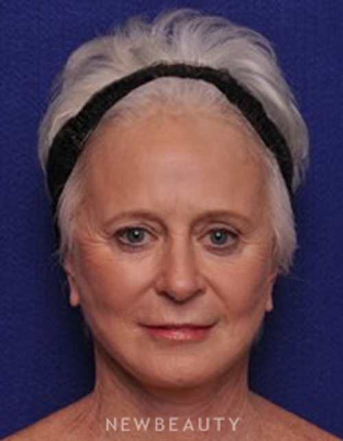 Dr. Alan Durkin - Facelift - After
