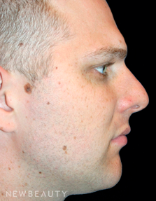 Dr. Kelly Bomer Rhinoplasty - Before