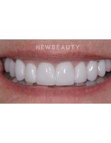 Dr. Guy Lewis - Veneers - After