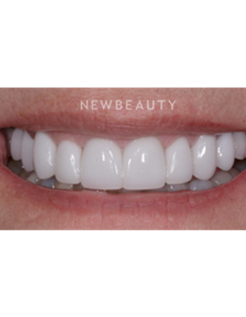 Dr. Guy Lewis - Veneers - After