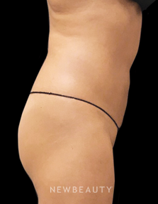 Dr. Janet Allenby - CoolSculpting - After