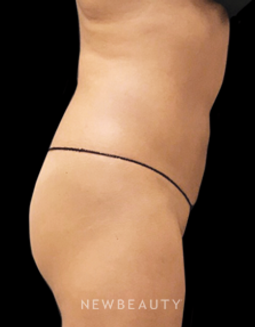 Dr. Janet Allenby - CoolSculpting - After