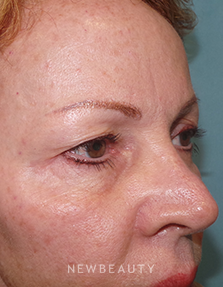 Dr. Sean Simon - Lasers - Before