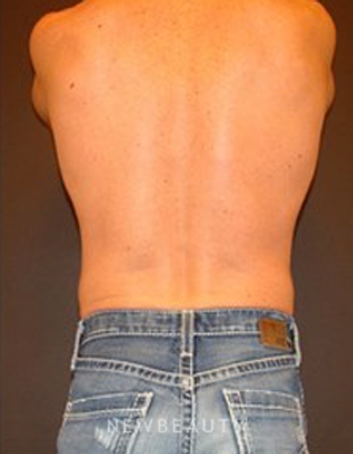 Dr. Joel Schlessinger - Coolsculpting - After