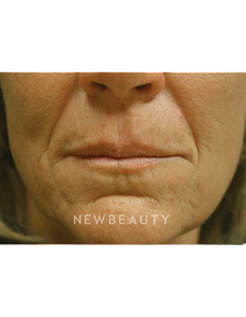 Dr. Kenneth Beer Injectables & Fillers - Before