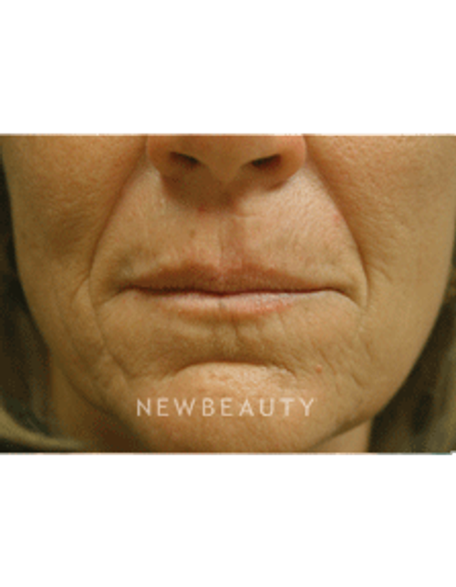 Dr. Kenneth Beer Injectables & Fillers - Before