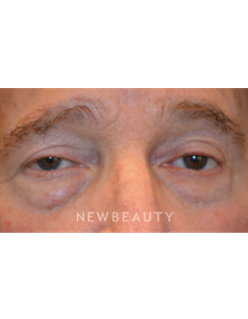 Dr. B. Aviva Preminger - Natural-Looking Results - Before