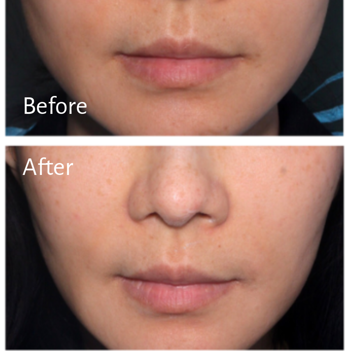 Masseter botox before and after shows facial slimming on Dr. Elaine Kung