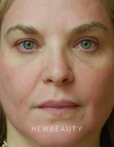 Dr. Kenneth Beer Fraxel Skin resurfacing - After