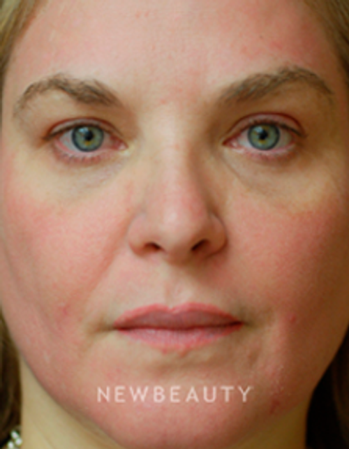 Dr. Kenneth Beer Fraxel Skin resurfacing - After