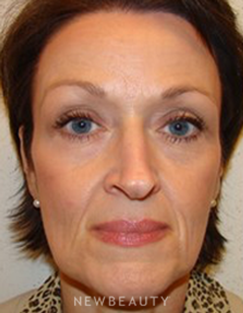 Dr. Joel Schlessinger - Botox - Before