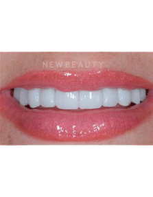 Dr. Guy Lewis Veneers - After