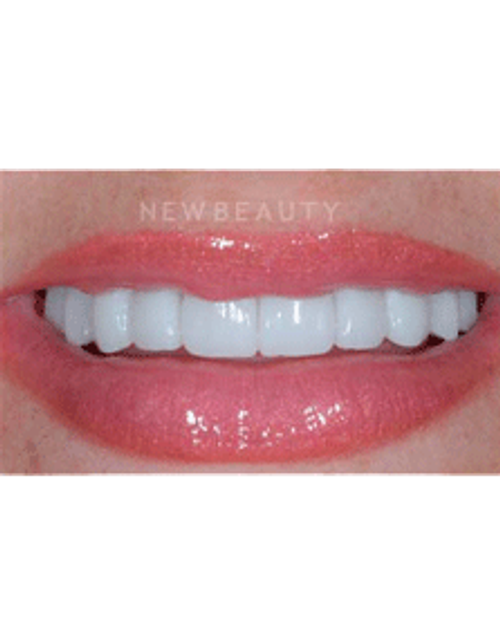 Dr. Guy Lewis Veneers - After