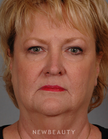 Dr. Henry Mentz Facelift, Eye Lift, Neck lift, Lasers - Before