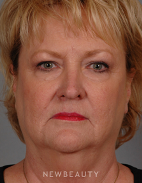 Dr. Henry Mentz Facelift, Eye Lift, Neck lift, Lasers - Before