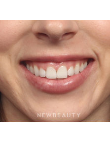 Dr. Kelly Bomer - Botox - Before