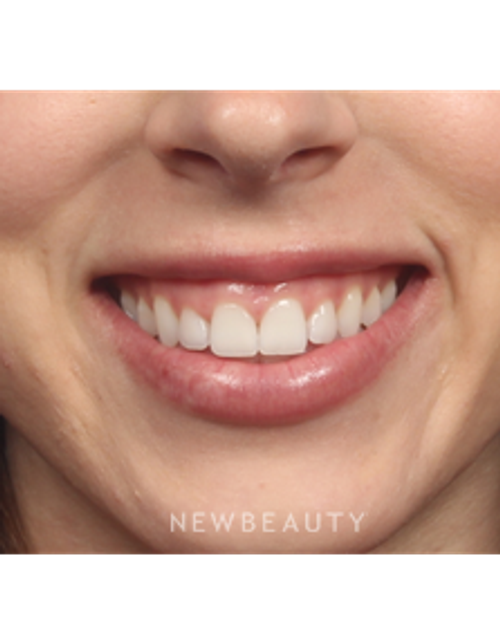 Dr. Kelly Bomer - Botox - Before