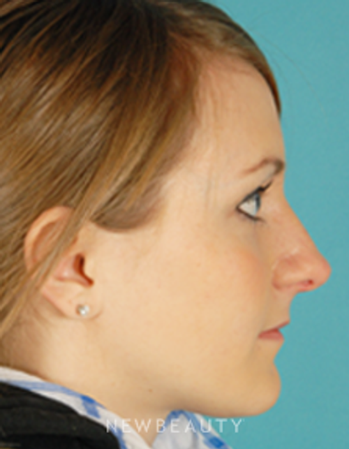 Dr. David Kim Rhinoplasty - After