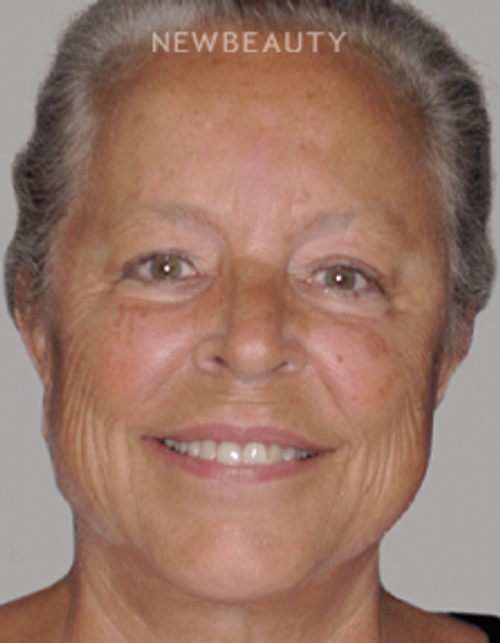 Dr. Salvator La Mastra - Smile Makeover -46108276 - Before
