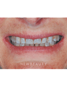 Dr. Guy M. Lewis - Smile Makeover - Before