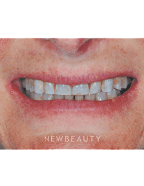 Dr. Guy M. Lewis - Smile Makeover - Before