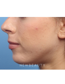 Dr. Kelly Bomer - Radiesse - After