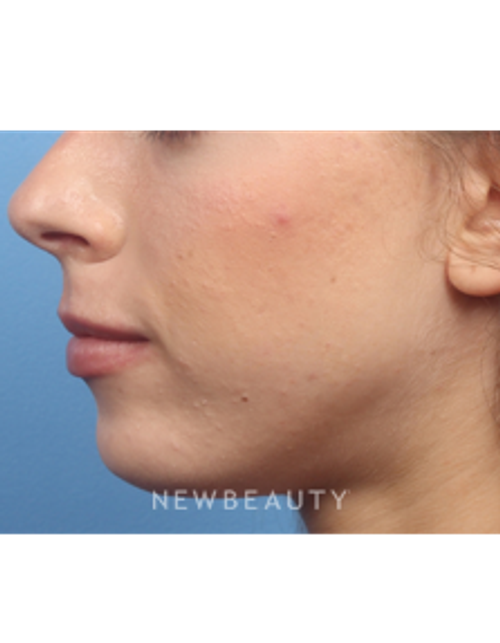 Dr. Kelly Bomer - Radiesse - After
