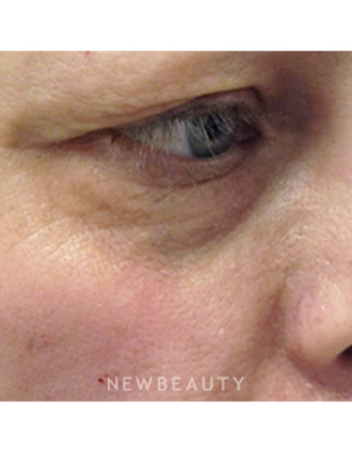 Dr. Kally Papantoniou - Pixel CO2 Laser Resurfacing - After