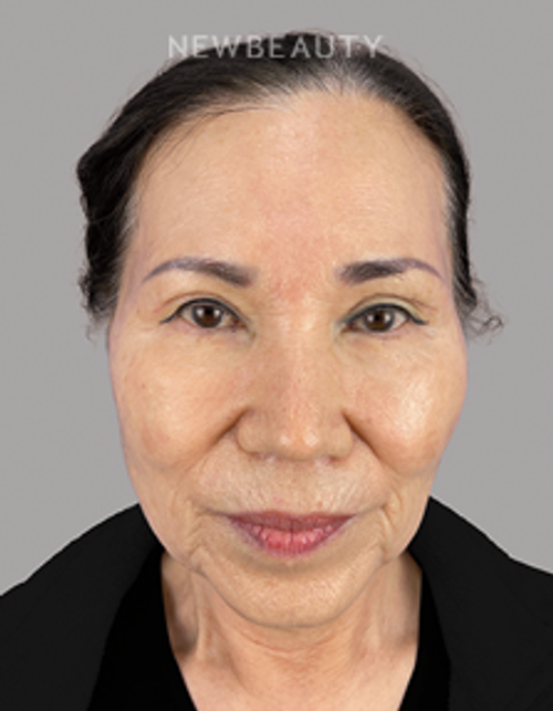 Dr. Sheila Barbarino-Blepharoplasty-547989840 - After