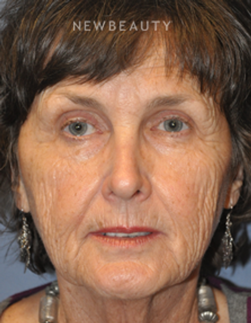 Dr. Bryan W. Gawley - Facelift - Before
